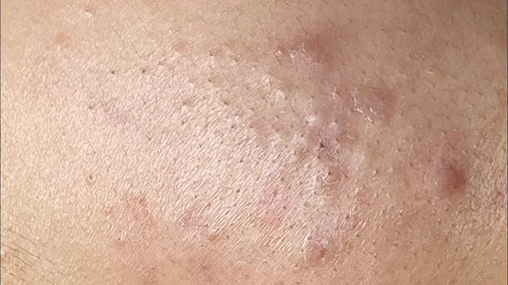 Relaxing Acne Treatment #74(Linh My Dang)