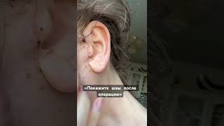 Швы после операции подтяжки лица #обучениекосметологов #лифтингмосква #фейсбилдинг