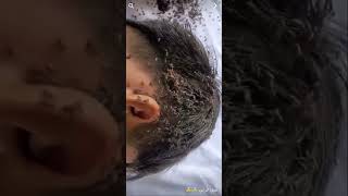 علاج القمل ??  head lice