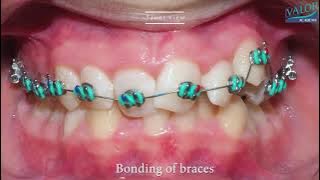 BRACES - The Magic of Orthodontics in 4K 💕 Braces time lapse.