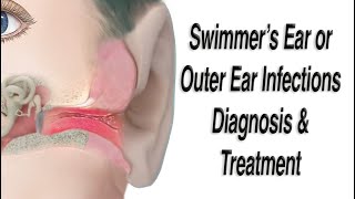 Outer Ear Infections, aka Swimmer's Ear Infections, Acute Otitis Externa: Diagnosis and Treatment