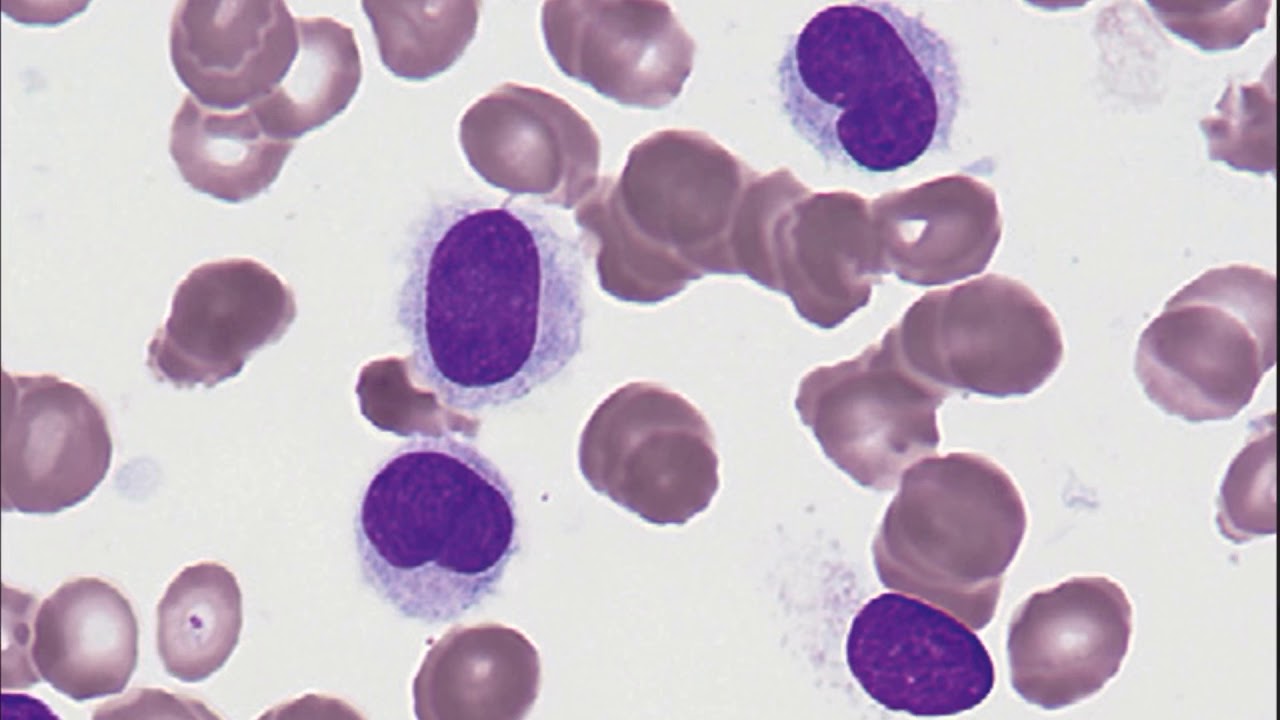 Hairy Cell Leukemia YouTube
