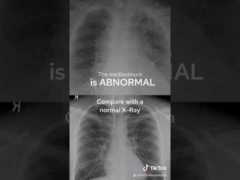 Video: Radiografija prsa