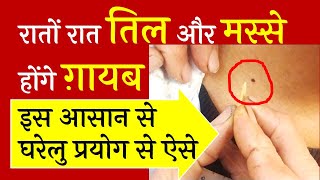 तिल Moles और मस्से होंगे रातों रात ग़ायब इस घरेलु प्रयोग से How to Remove Moles Safe Home Remedie