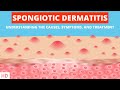 The Itchy Truth: Spongiotic Dermatitis Unveiled