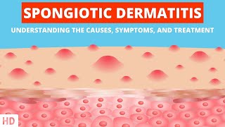 The Itchy Truth: Spongiotic Dermatitis Unveiled