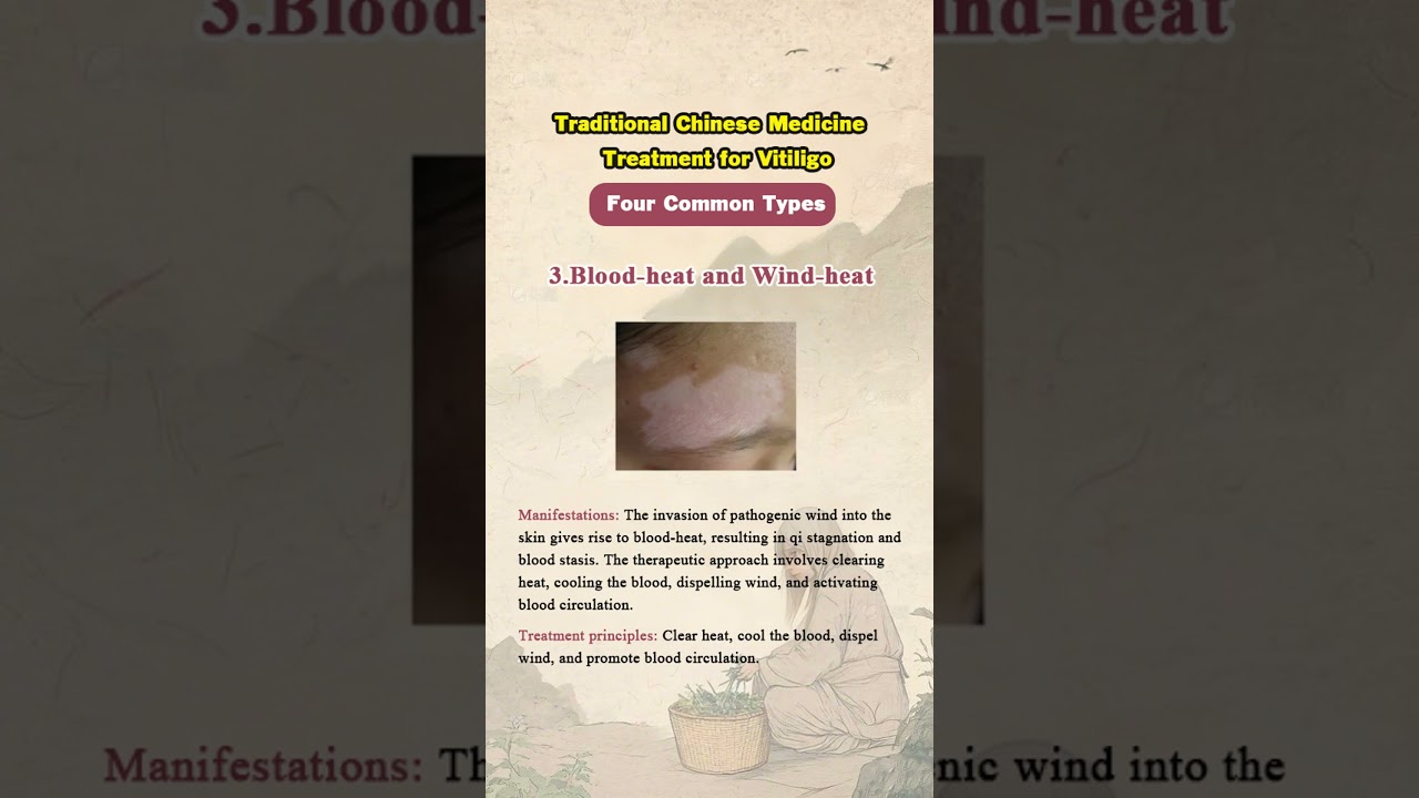 Traditional Chinese Medicine For Vitiligo  