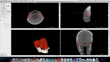 2a etapa - ITK SNAP: i) Finalização de segmentação final de maxila e adjacentes, parte esquelética