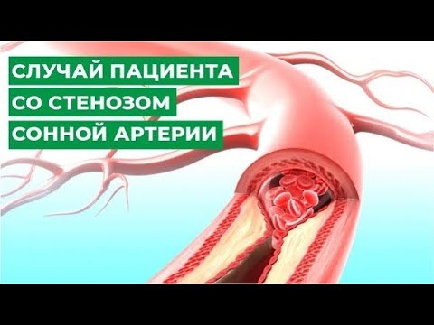 Видео: Безопасно ли стентирование сонных артерий?