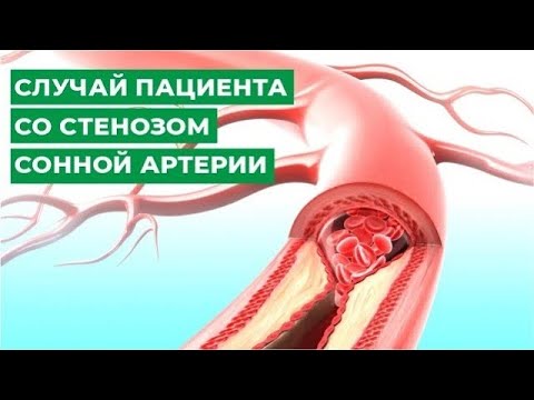 Общая сонная артерия: топография, ветви, области кровоснабжения