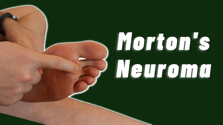 Top Progressive Exercises for Morton's Neuroma Relief | Irish Physios Guide