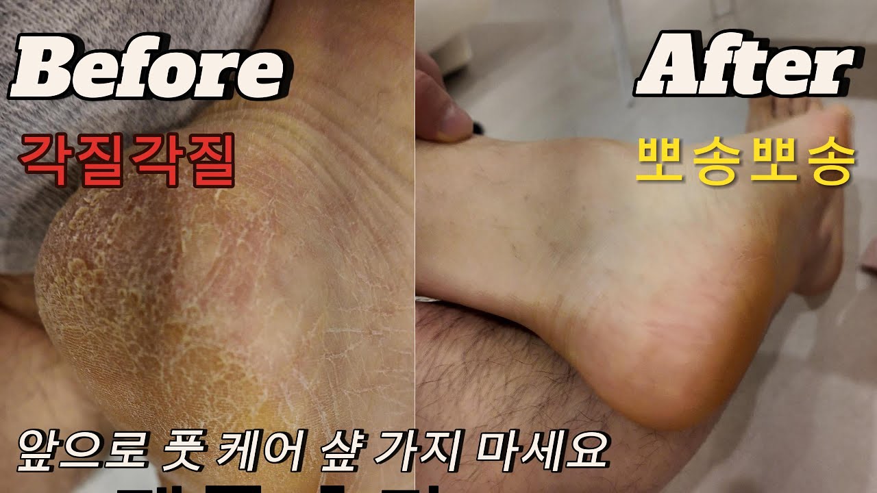 (위험-비위 약하신 분은 시청 금지)집에서 셀프로 썩은 발의 각질 제거하는 스캐리브라덜 #발각질제거 #발각질관리 #발각질 #굳은살 #제품리뷰 #풋케어 #footcare #발톱무좀
