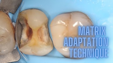 INVAGINATION MANAGEMENT AND DEEP MARGIN ELEVATION TECHNIQUE