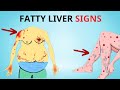 A silent threat 8 signs that could indicate fatty liver disease  healthy care