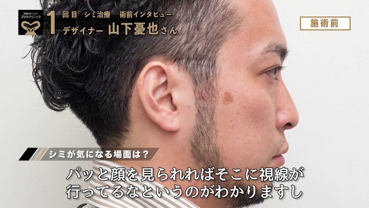 メンズスキンケア 山下憂也さん01 男のシミ治療 に挑戦 Youtube