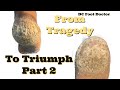 From tragedy to triumph part 2 thick cracked callused heels