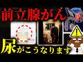 【超意外な初期症状】放置厳禁!知らないと後悔する前立腺がん。まさかの「足」と「尿」の危険サイン。残尿感.夜間頻尿.浮腫.意外な兆候とは?日本で急増している前立腺がんの予防法とは。医師が徹底解説。