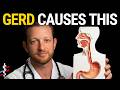 Sleep Apnea Secondary to GERD: The VA Claim That Adds 50% to Your Rating