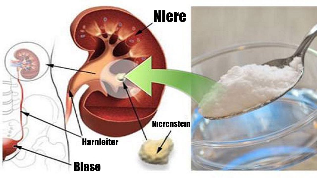 Ein Teelöffel davon pro Tag kann deine beschädigte Niere natürlich ohne Medikamente reparieren!