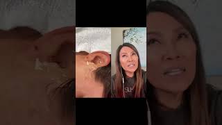  Insect In Ear Dr Pimple Popper Reacts