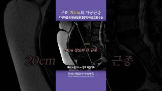 30대 여성, 자궁근종 크기만 무려 20cm!! 로봇수술 결과는 과연?!