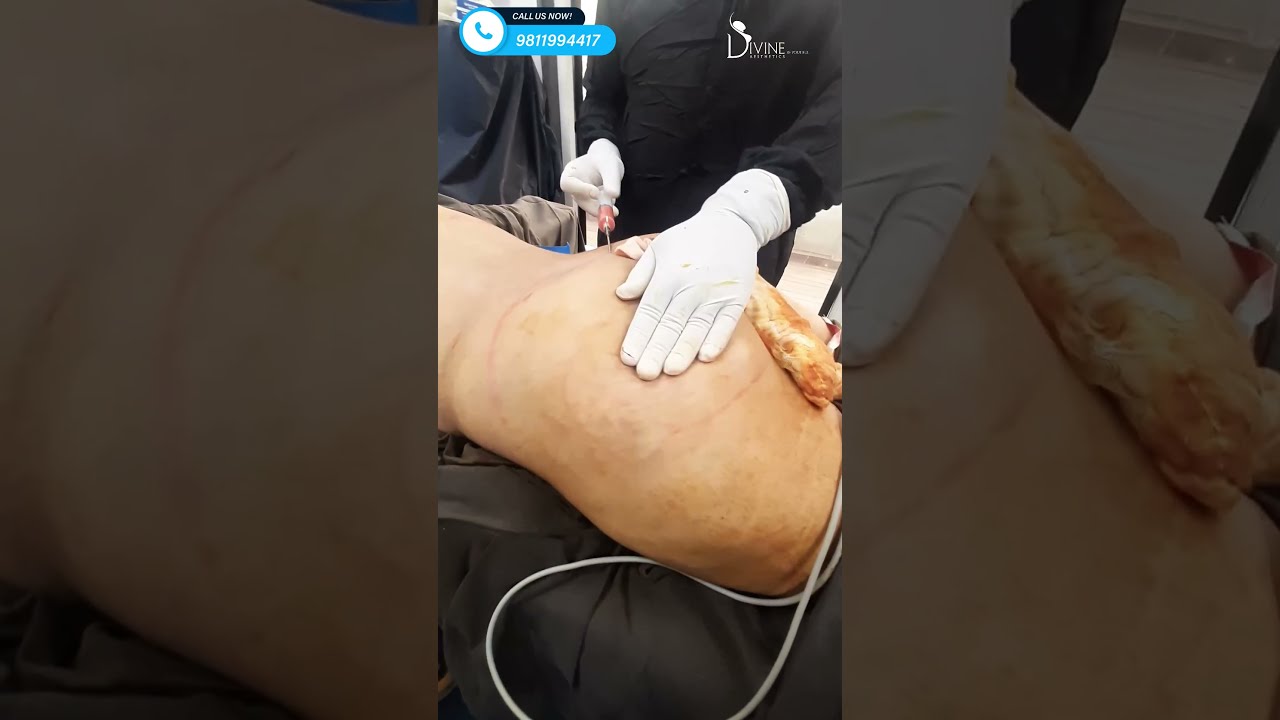 Butt Augmentation Using Fat Grafting And Result Brazilian Lift In Delhi Shortfeed Shorts