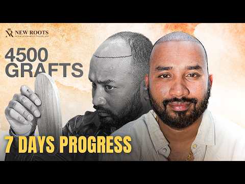 My Brother Recommended This Hair Transplant Clinic in Siliguri ❤️ | Best Cost and Results | Hindi