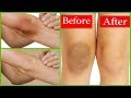 Lighten Dark Knees/ Elbows and Finger Joints with Lemon & Baking Soda in 1 Week / Rabia Skin Care