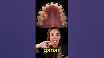 ¿Pueden moverse los dientes en un día?