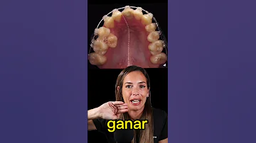 ¿Se mueven los dientes con los aparatos?