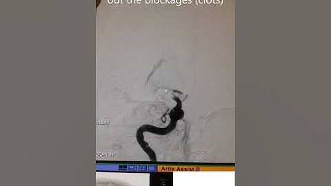 Endovascular clot retrieval (neurothrombectomy)