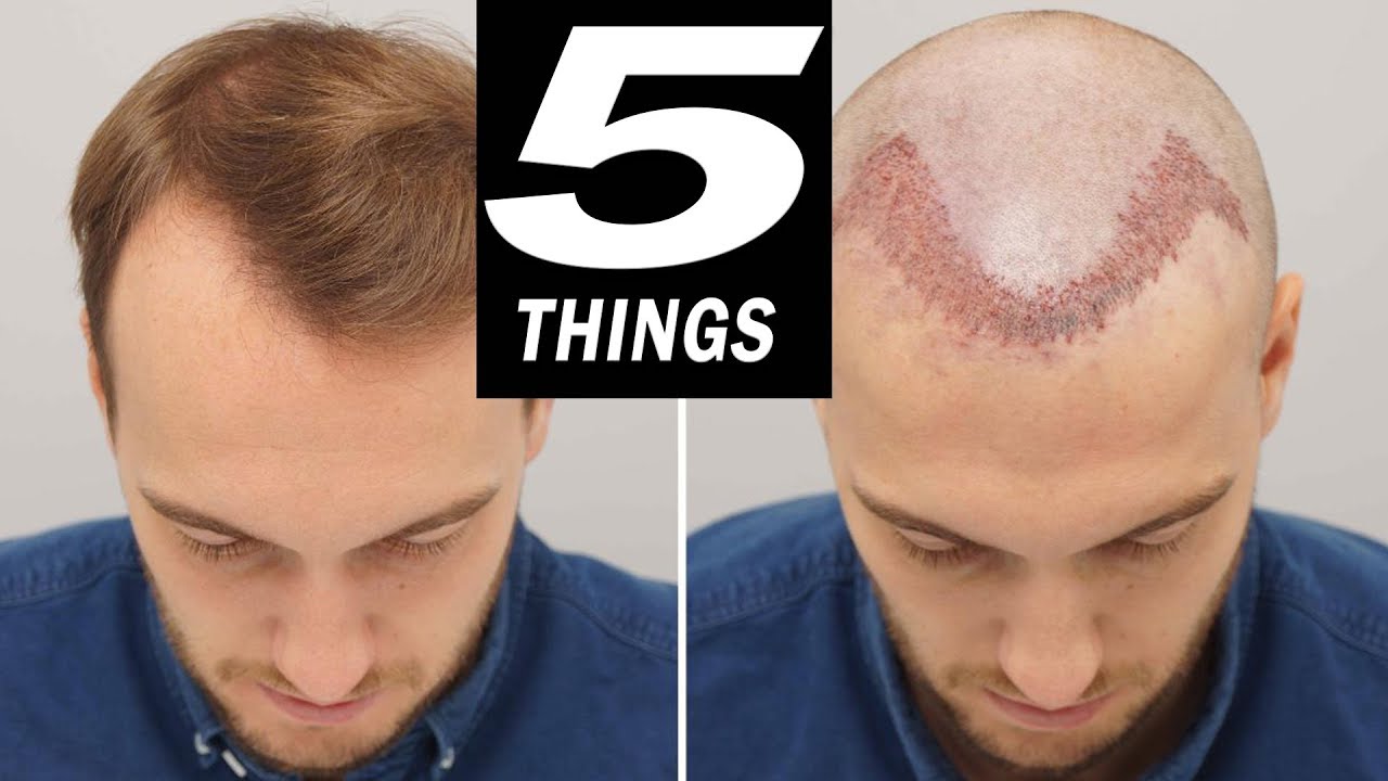 5 THINGS to do after HAIR TRANSPLANT! - YouTube