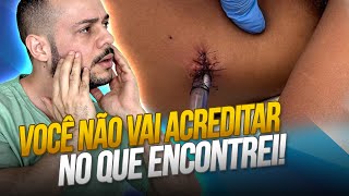 Radiografia De Tórax Com Surpresa Inusitada Dr Thiago Explica