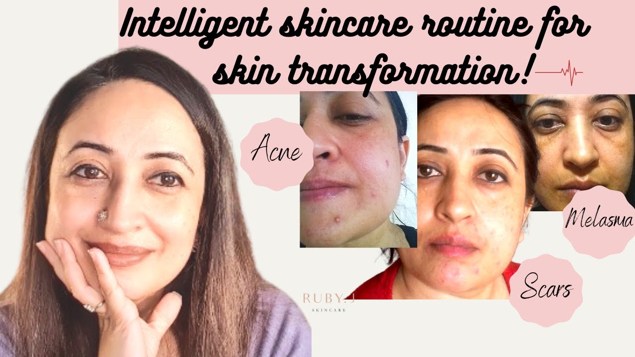 My Detailed AM/PM Skincare Routine for Fading Pigmentation, Acne, Acne Scars | FIRST Update