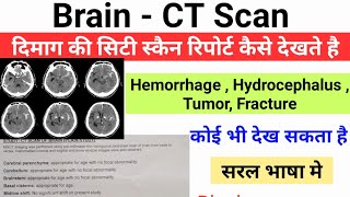 Brain CT Scan report कैसे देखते है || Brain CT Scan in simple language screenshot 4