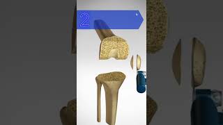 Total Knee Replacement (TKR) #kneejoint #kneeanatomy #knee screenshot 2