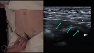 Ultrasound femoral and inguinal hernia video recording 21M hernia
