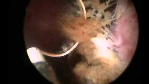 Bladder tumour removal - The Prostate Clinic