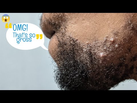 Video: Forskjellen Mellom Zit Og Pimple