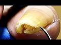 Ingrown Nails Are Long And Curly, Cut Off The Excess Nails【Xue Yidao】