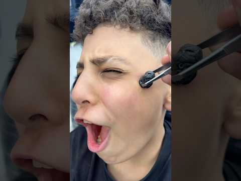 ازالة الحباية المتسلطنة من الخد