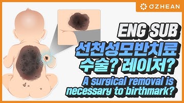 (ENG SUB) 선천성 모반 수술이 필요할까? A surgical removal is necessary to birthmark? - 오체안성형외과 이용석 원장님