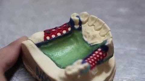 Metal Framework RPD waxing Procedure