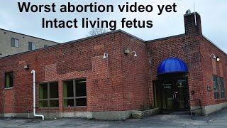 Worst abortion video yet: Intact living fetus; Don't just defund Planned Parenthood; Shut them down