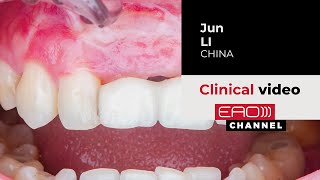 Customized Titanium Mesh For Reconstruction Of Composite Bone Defects In Maxillary Anterior Teeth