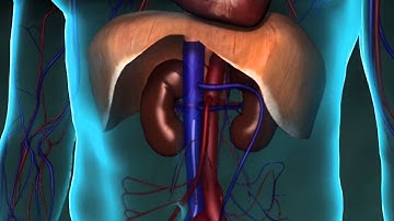Retrievable IVC Filter Failure