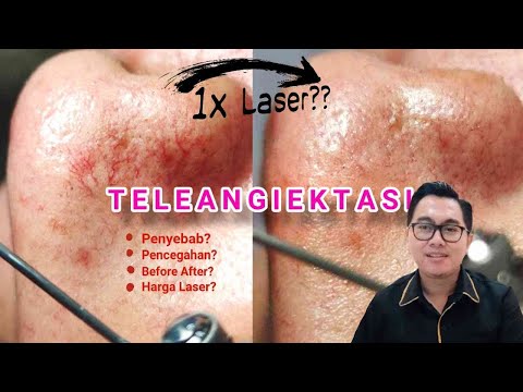 Video: 3 Cara Menghilangkan Kapilari Pecah di Muka Anda