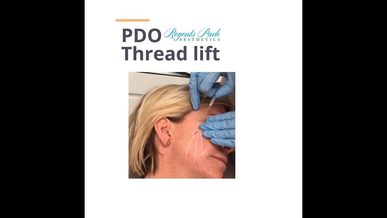 PDO Thread lift YouTube