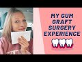 Gum Graft Experience | Surgery Day - 3 Days Post Graft | Journey to Dental Implants