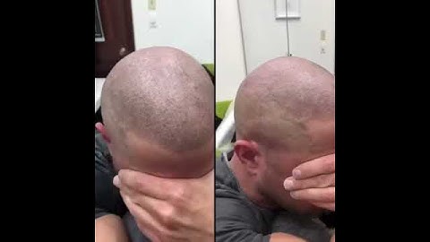 Scalp Micropigmentation by Antonio Baroque